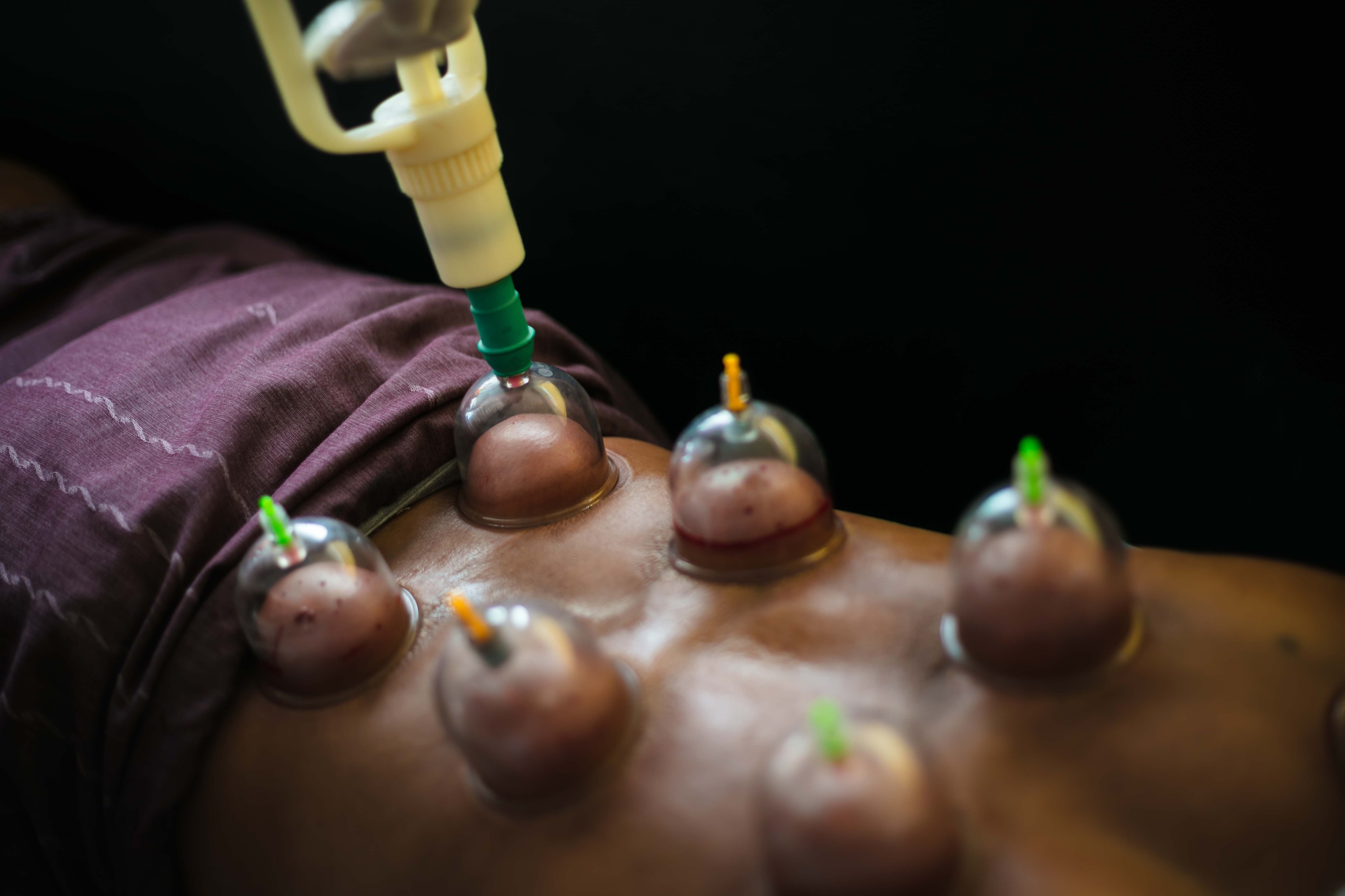 Cupping